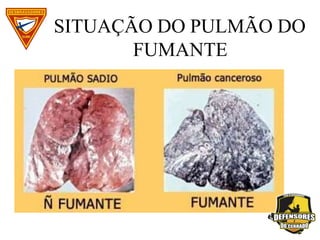 SITUAÇÃO DO PULMÃO DO
FUMANTE
 