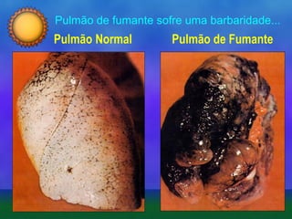 Pulmão de fumante sofre uma barbaridade...

Pulmão Normal

Pulmão de Fumante

 