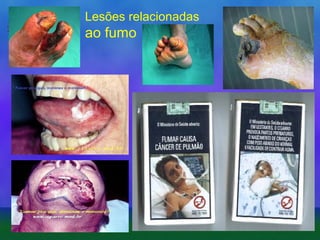 Lesões relacionadas

ao fumo

 