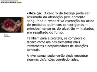 Bexiga : O cancro da bexiga pode ser resultado da absorção pela corrente sanguínea e respectiva excreção na urina de produtos químicos cancerígenos — principalmente os do alcatrão — inalados em resultado do fumo. Também para a próstata, se comprova o tabaco como um dos elementos mais intoxicantes e despoletadores de situações tumorais. A nível sexual poder-se-ão ainda encontrar algumas disfunções correlacionadas. Bexiga cancerosa 