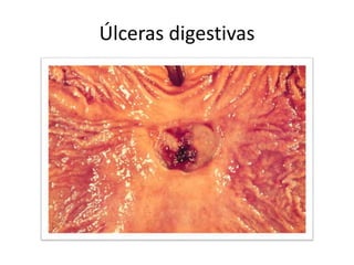 Úlceras digestivas
 