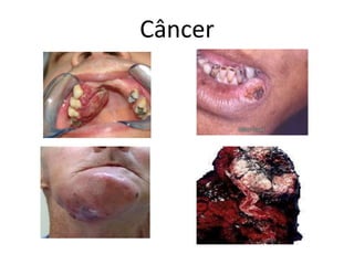 Câncer
 