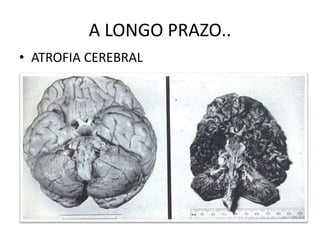 A LONGO PRAZO..
• ATROFIA CEREBRAL
 