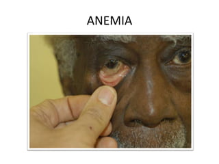ANEMIA
 