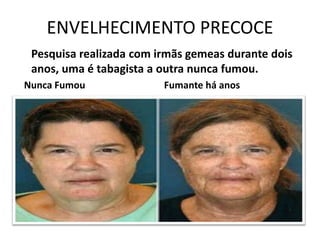 ENVELHECIMENTO PRECOCE
Pesquisa realizada com irmãs gemeas durante dois
anos, uma é tabagista a outra nunca fumou.
Nunca Fumou Fumante há anos
 