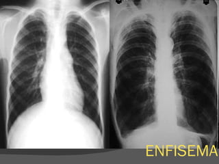 ENFISEMA 