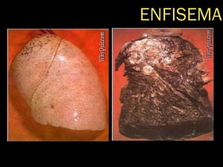 ENFISEMA 