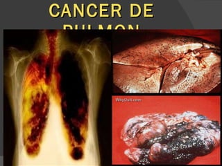 CANCER DE PULMON 