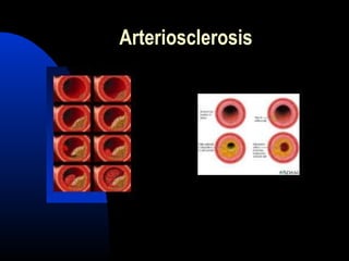 Arteriosclerosis
 
