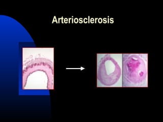 Arteriosclerosis
 
