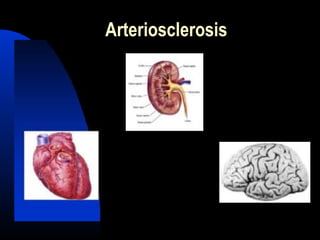 Arteriosclerosis
 