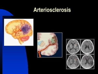 Arteriosclerosis
 