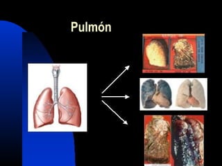 Pulmón
 