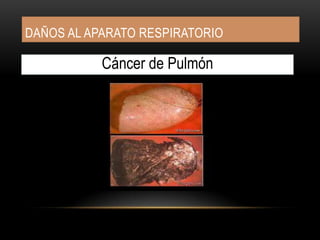 DAÑOS AL APARATO DIGESTIVOCáncer de Esófago
