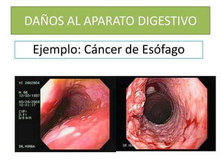 DAÑOS AL APARATO DIGESTIVOEjemplo: Cáncer de Esófago