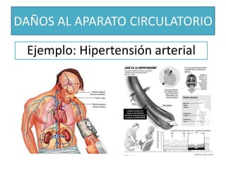 DAÑOS AL APARATO CIRCULATORIOEjemplo: Hipertensión arterial