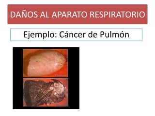DAÑOS AL APARATO RESPIRATORIOEjemplo: Cáncer de Pulmón