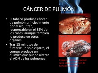 CÁNCER DE PULMÓN
• El tabaco produce cáncer
de pulmón principalmente
por el alquitrán,
responsable en el 85% de
los casos, aunque también
lo produce en otros
órganos.
• Tras 15 minutos de
fumarse un solo cigarro, el
cuerpo produce un
químico que puede alterar
el ADN de los pulmones Imagen 5. Arriba un pulmón
sano, abajo un pulmón de
fumador con cáncer
 