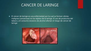 CANCER DE LARINGE
 El cáncer de laringe es una enfermedad por la cual se forman células
malignas (cancerosas) en los tejidos de la laringe. El uso de productos del
tabaco y el consumo excesivo de alcohol afectan el riesgo de cáncer de
laringe.
 