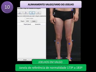 10
ALINHAMENTO VALGO/VARO DO JOELHO
Janela de referência de normalidade 173º a 183º
JOELHOS EM VALGO
 