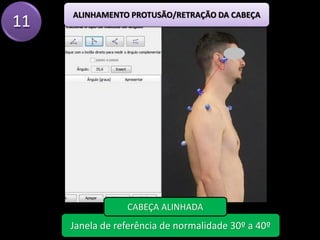 11
Janela de referência de normalidade 30º a 40º
CABEÇA ALINHADA
ALINHAMENTO PROTUSÃO/RETRAÇÃO DA CABEÇA
 