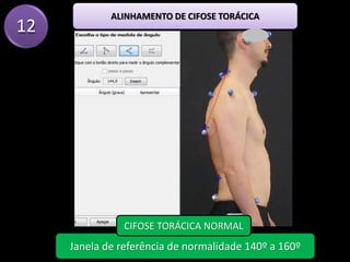 12
ALINHAMENTO DE CIFOSE TORÁCICA
Janela de referência de normalidade 140º a 160º
CIFOSE TORÁCICA NORMAL
 