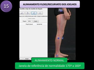 15
ALINHAMENTO FLEXO/RECURVATO DOS JOELHOS
Janela de referência de normalidade 175º a 183º
ALINHAMENTO NORMAL
 
