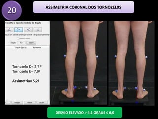 20
Tornozelo D= 2,7 º
Tornozelo E= 7,9º
Assimetria= 5,2º
DESVIO ELEVADO > 4,1 GRAUS ≤ 6,0
ASSIMETRIA CORONAL DOS TORNOZELOS
 