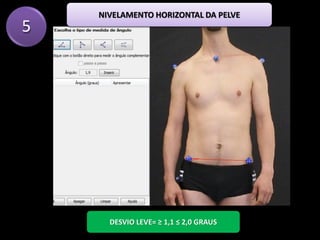 5
DESVIO LEVE= ≥ 1,1 ≤ 2,0 GRAUS
NIVELAMENTO HORIZONTAL DA PELVE
 
