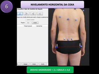 6
DESVIO MODERADO > 2,1 GRAUS ≤ 4,0
NIVELAMENTO HORIZONTAL DA COXA
 