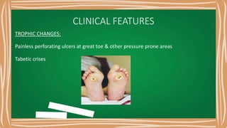 CLINICAL FEATURES
TROPHIC CHANGES:
Painless perforating ulcers at great toe & other pressure prone areas
Tabetic crises
 