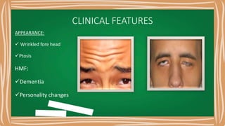 CLINICAL FEATURES
APPEARANCE:
 Wrinkled fore head
Ptosis
HMF:
Dementia
Personality changes
 