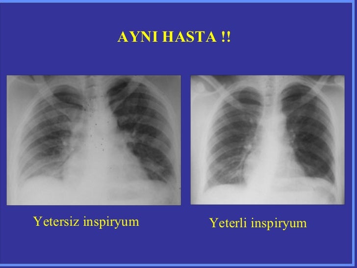 Burada yaklaşık yapmalıyım Whay olduğu hipertansiyon ilaçları nelerdir