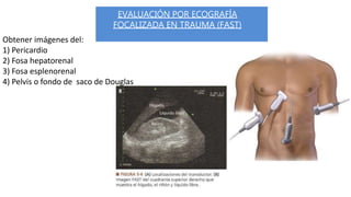 EVALUACIÓN POR ECOGRAFÍA
FOCALIZADA EN TRAUMA (FAST)
Obtener imágenes del:
1) Pericardio
2) Fosa hepatorenal
3) Fosa esplenorenal
4) Pelvis o fondo de saco de Douglas
 