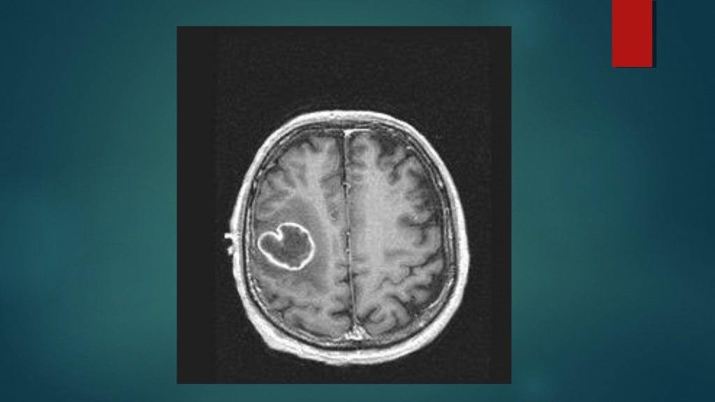 Tac normal,patologica