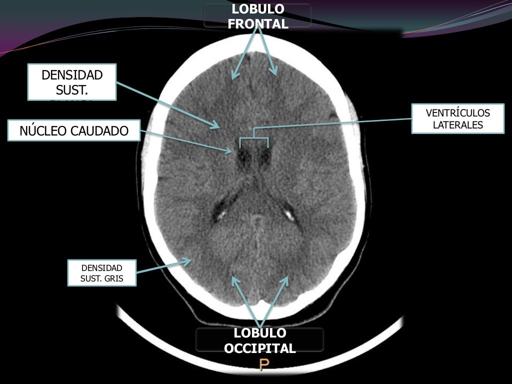 Como Interpretar Una Tac De Craneo
