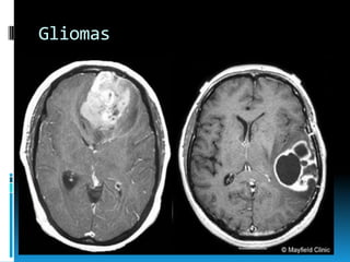 Gliomas

 