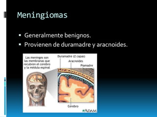 Meningiomas
 Generalmente benignos.
 Provienen de duramadre y aracnoides.

 