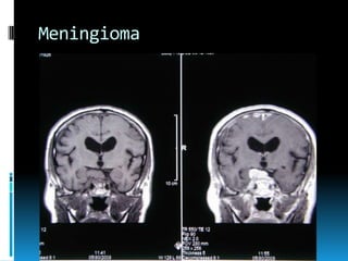 Meningioma

 