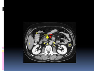 tac-higado-pancreas-y-vesicula-biliar-pptx