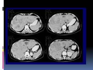tac-higado-pancreas-y-vesicula-biliar-pptx