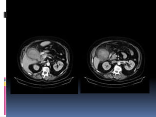 tac-higado-pancreas-y-vesicula-biliar-pptx