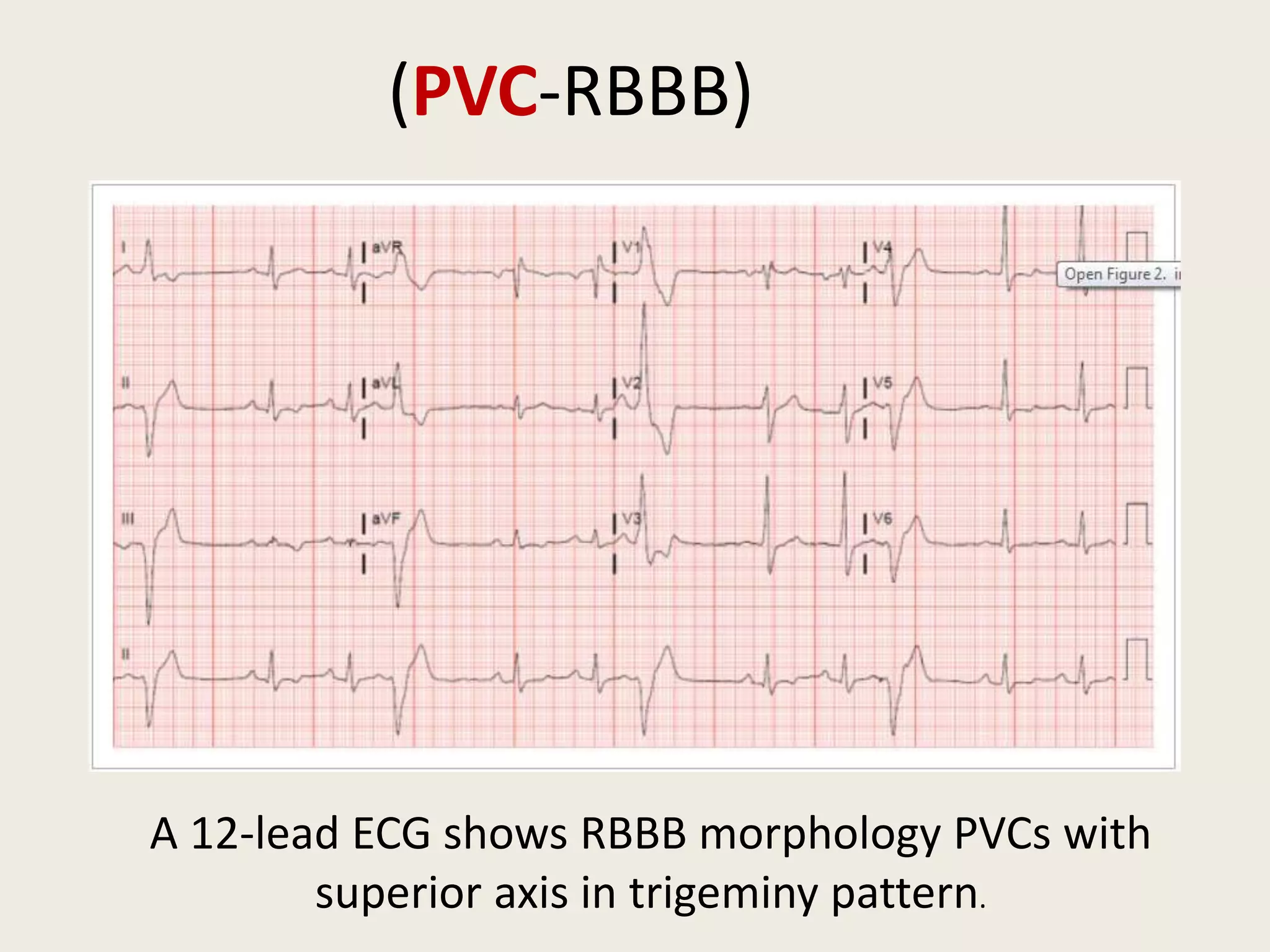 A 12-lead ECG shows RBBB morphology PVCs with
superior axis in trigeminy pattern.
(PVC-RBBB)
 
