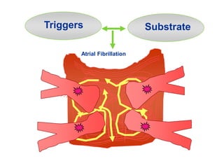 Triggers
Atrial Fibrillation
Substrate
 