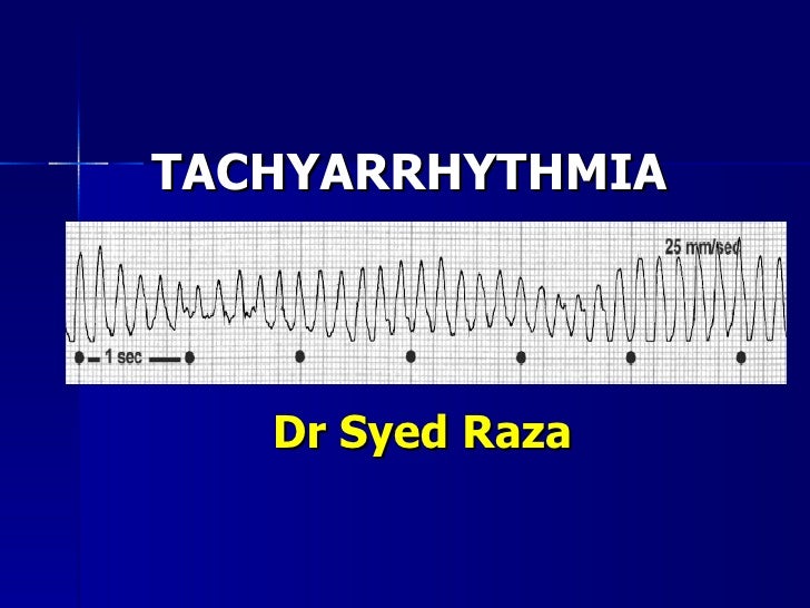 Tachyarrhythmia