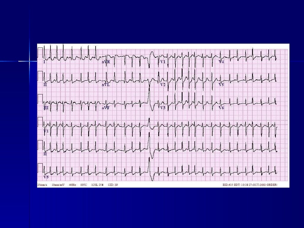 Tachyarrhythmia