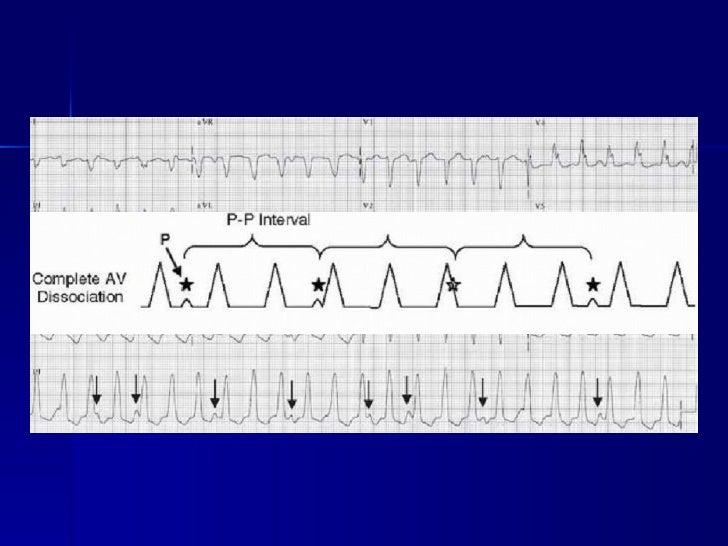Tachyarrhythmia