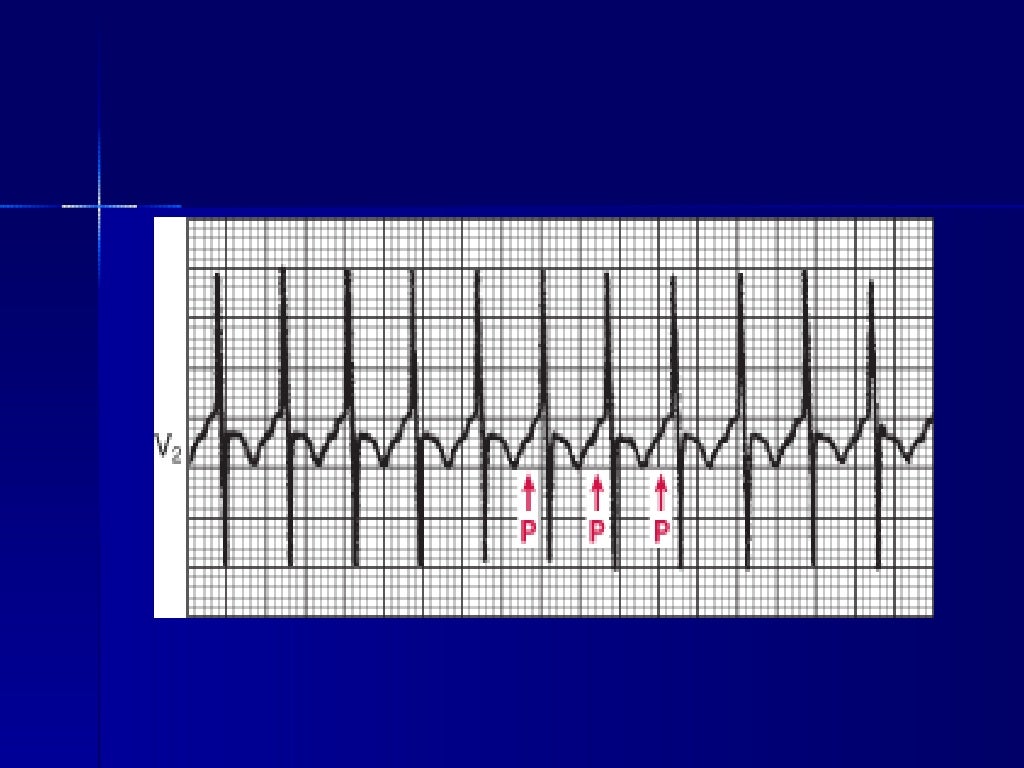 Tachyarrhythmia