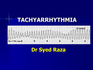 TACHYARRHYTHMIA  Dr Syed Raza 