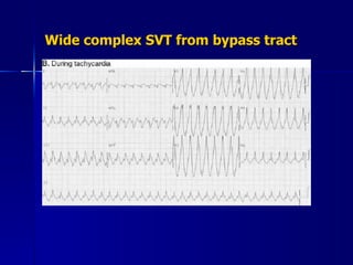 Wide complex SVT from bypass tract 